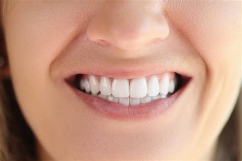 Porcelain Dental Veneers Burns Dentistry