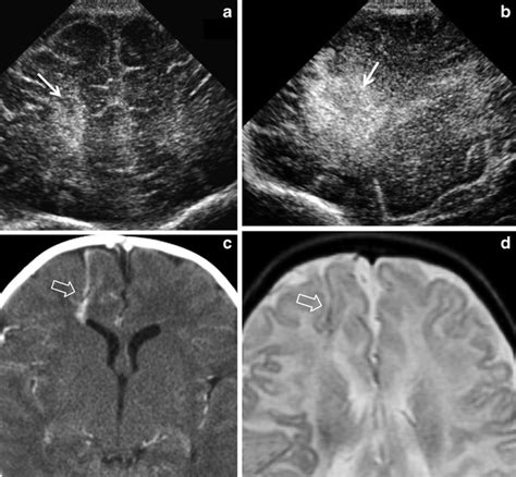 Developmental Venous Anomaly Dva In A 6 Day Old Girl With Full