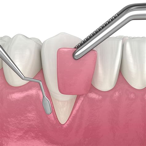Is The Gum Graft Procedure Painful West Houston Periodontics And