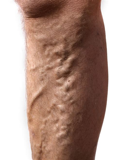 Varicose Vein Disease In Men Michigan Vein Care Specialists