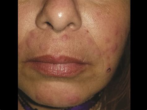 Painful Itchy Facial Rash Clinical Advisor