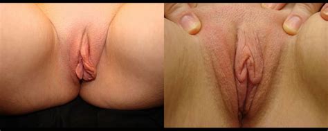 Patient Labiaplasty Before And After Photos Baltimore Plastic