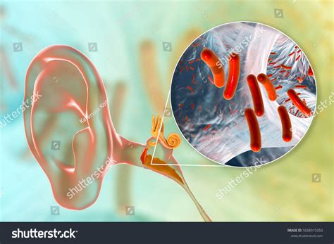 Otitis Media Inflammatory Disease Middle Ear Stock Illustration