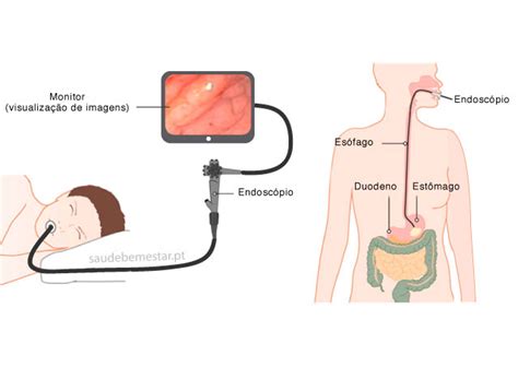 Endoscopia Digestiva Alta Passo Fundo Endoclin Passo Fundo