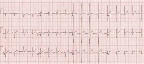 R Wave Litfl Ecg Library Basics