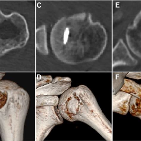Avulsion Fracture Of Lesser Tuberosity Was Assessed By 3D CT Pre And