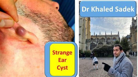 Large Cyst LipomaCyst Com Dr Khaled Sadek YouTube