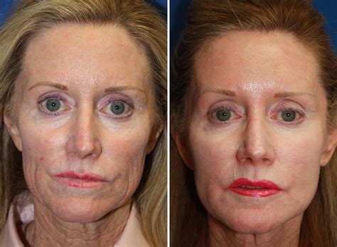 Dermal Fillers Pictures Boston Ma Patient 8828