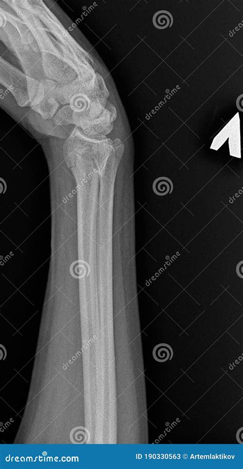X Ray Image Of Cracked Human Bone Wrist Fracture Stock Image Image