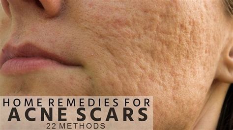 So, let's quickly get into some of the best and effective natural treatments with home remedies for acne scars. Home Remedies for Acne Scars on Face (22 Methods) | Hira ...