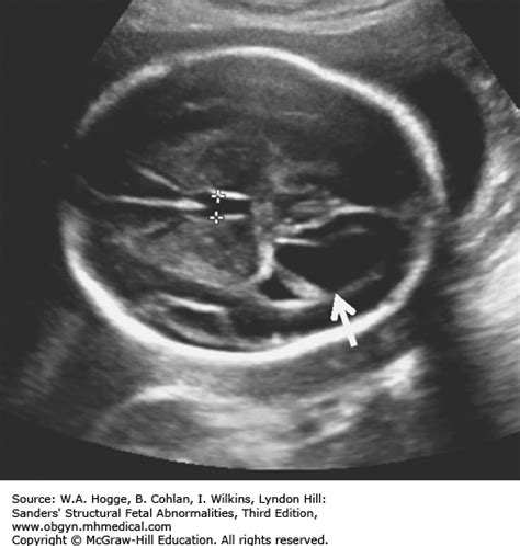 Fetal Brain Ultrasound Images