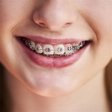 When To See An Orthodontist Holliston Ortho Issues Simply Orthodontics