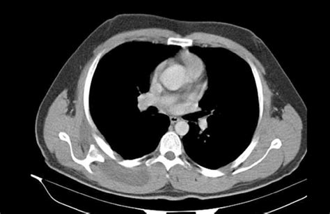 Preoperative Coronal Ct Scan Of Ventral Scapular Osteochondroma