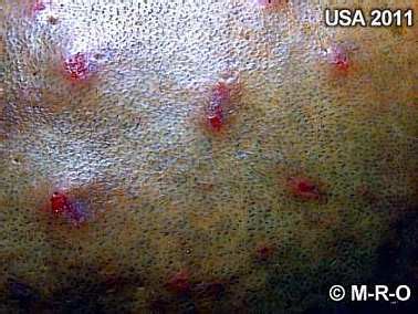 Morgellons ist der name dieser krankheit, die durch hautgeschwüren mit bunten herausragenden fibrillen gekennzeichnet ist. wissenlebens - ! Chemtrail - Morgellons