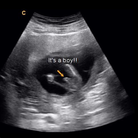 Early Gender Boys 15 Weeks 3d 4d 5d Hd Ultrasound Michigan
