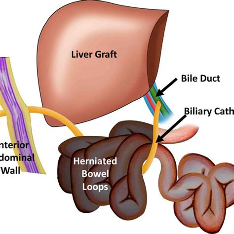 Pdf Internal Hernia Of The Small Intestine Around Biliary Catheter