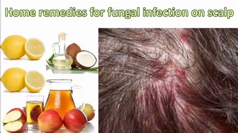 Home Remedies For Fungal Infection In Scalp Rowena Leyte Youtube