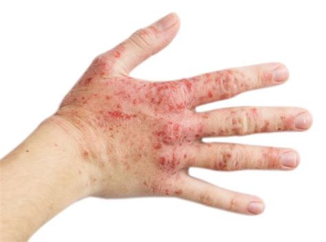 Guttate Psoriasis Causes And Natural Treatment Health Wages