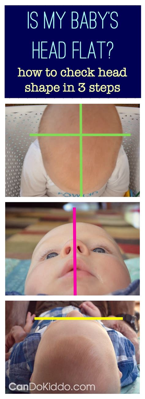 Positional Plagiocephaly Is My Babys Head Flat — Cando Kiddo