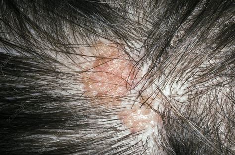 Sebaceous Naevus On The Scalp Stock Image C0033015 Science Photo