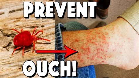 What Are Chiggers How To Treat Bites And How To Prevent Youtube