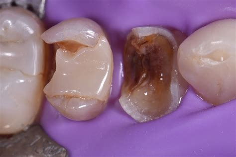 Restoration Of Severely Broken Down Teeth