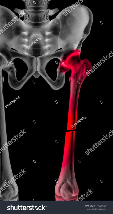 Xray Broken Upper Leg Femur Fracture Stock Illustration 1119939851