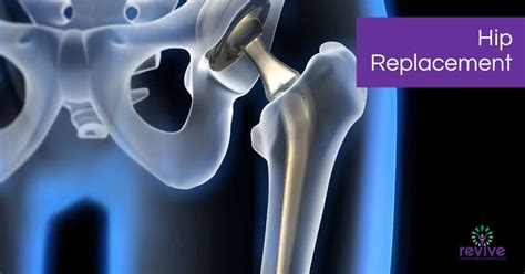 Hip Replacement | Revive Physio Therapy and Pilates