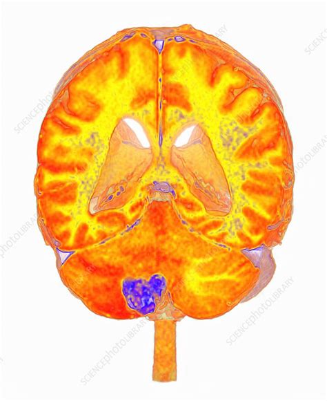 Metastatic Brain Cancer Mri Scan Stock Image C0457110 Science