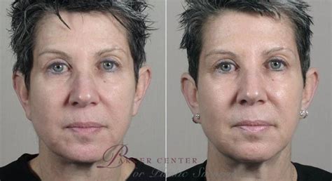 Nonsurgical Face Procedures Before And After Pictures Case 317