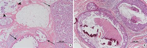 Figure 4 From Invasive Micropapillary Carcinoma In Axillary Ectopic
