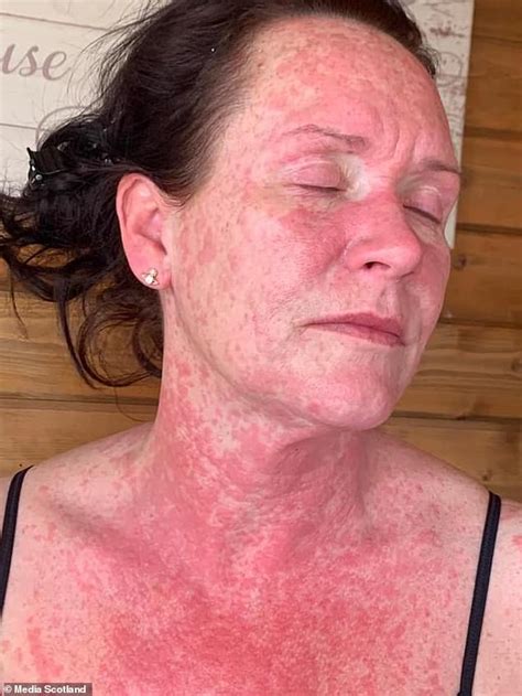 41 Year Old Woman Suffers Unbearable Burning Red Rash On Body From