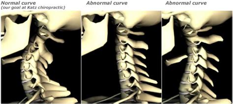 Help I Have A Reversed Cervical Curve — Musicians Health Collective