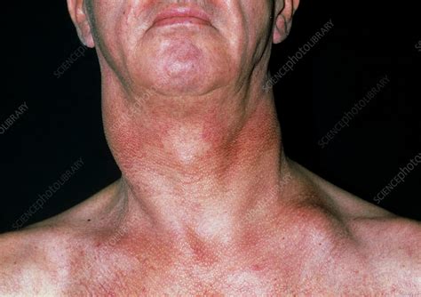 Cancer of lymph node - Stock Image - M131/0395 - Science Photo Library