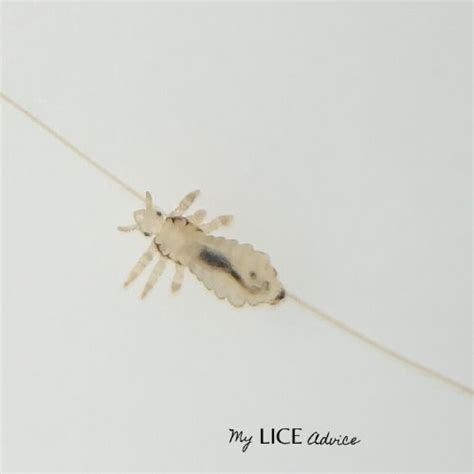 Discover 17 Common Head Lice Symptoms With Pictures And Find Out The