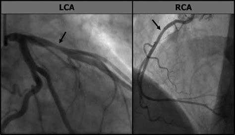 Exercise Induced Spastic Coronary Artery Occlusion At The Site Of A