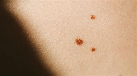 How Does A Cancerous Mole Look Like Symptoms And Pictures