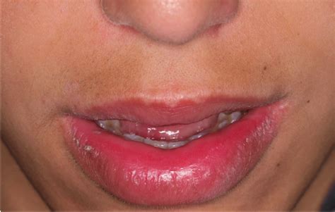 Inflammation On The Lips Lipstutorial Org