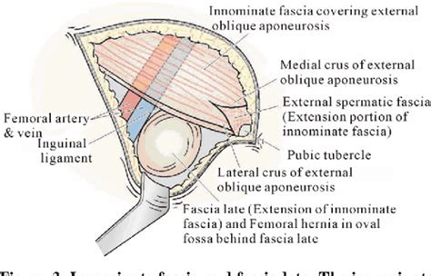 Femoral Hernia A Review Of The Clinical Anatomy And Surgical Treatment