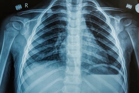 New Tips For Avoiding Mistakes In Pediatric Chest Radiography Wales