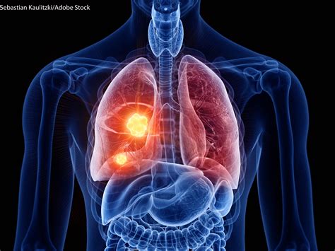 Extending Survival In Extensive Stage Small Cell Lung Cancer Cancer