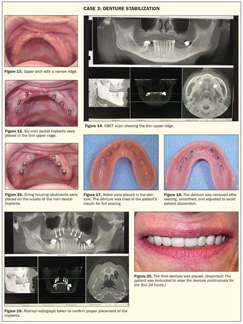 Minimally Invasive Mini Dental Implants Dentistry Today