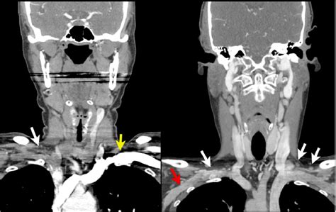 Figure 6 From Imaging Of The Supraclavicular Lymph Node In Routine