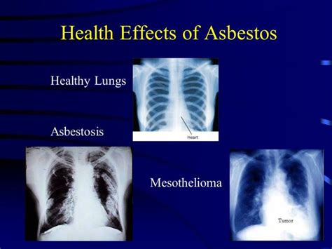 Mesothelioma is an aggressive and deadly form of cancer. Louisiana Judge Rules That Previous Asbestos Settlements ...