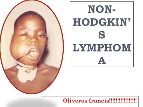 Lymphoma Non Hodgkins Lymphoma Stages