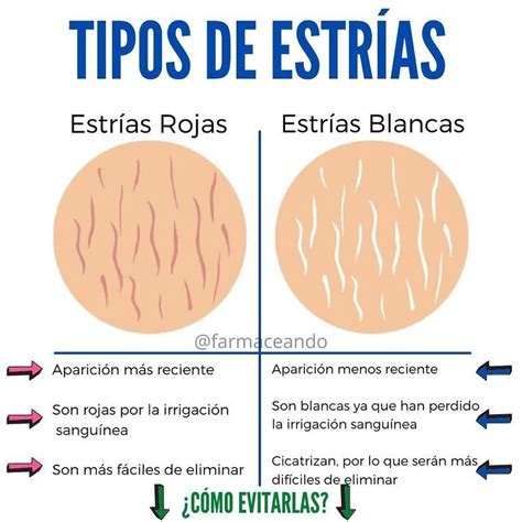 Tipos De Estrías Farmaceando