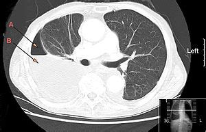 Ct scan of the chest. Pleural empyema - Wikipedia