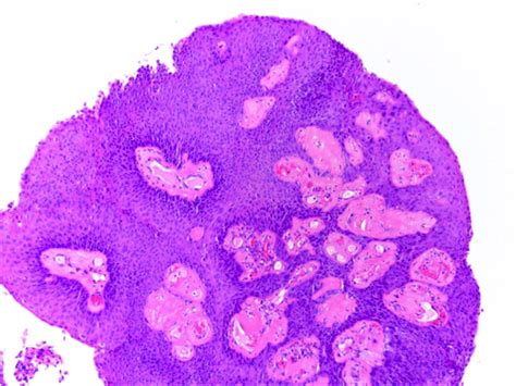 Pathology Outlines Squamous Glandular Mixed Papilloma