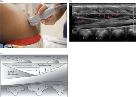Ultrasound Guided Lumbar Puncture Anesthesia Key
