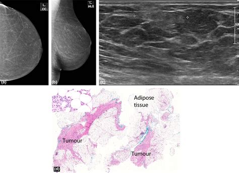 Malignant Hyperechoic Breast Lesions At Ultrasound A Pictorial Essay